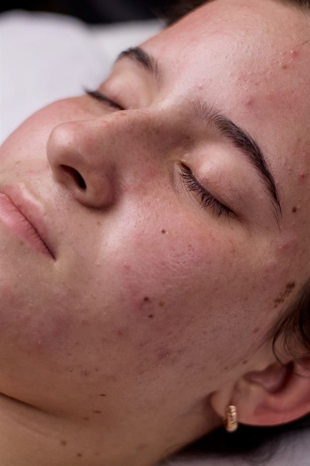 Primer plano del rostro de una clienta tras un tratamiento facial